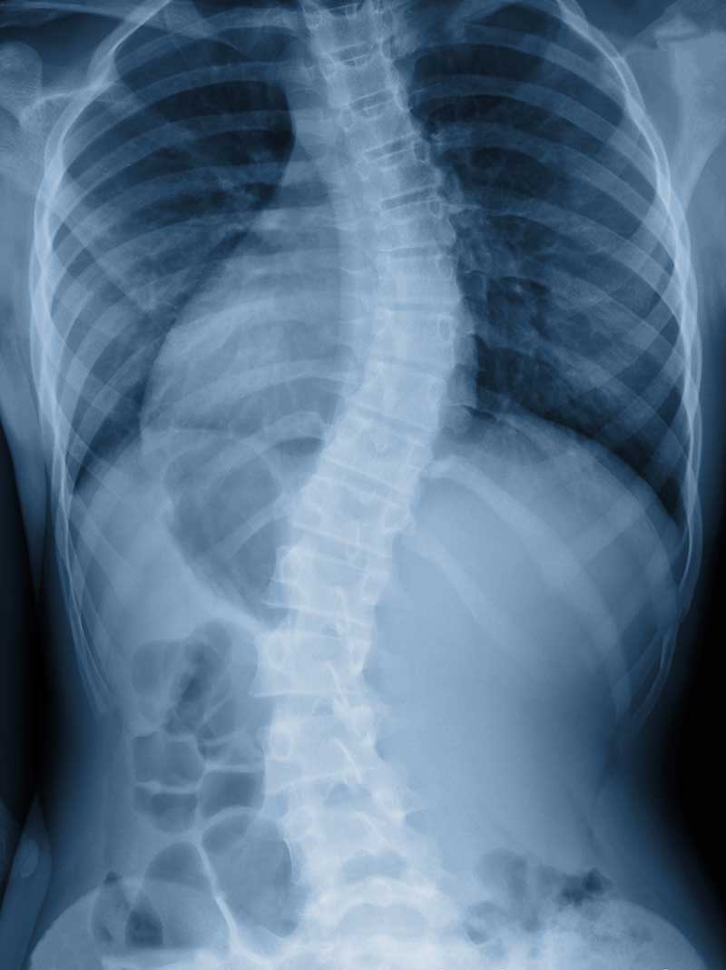 Scoliosis Palm Beach Gardens, FL